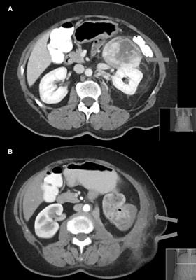 The Role of Surgical Expertise and Surgical Access in Retroperitoneal Sarcoma Resection – A Retrospective Study